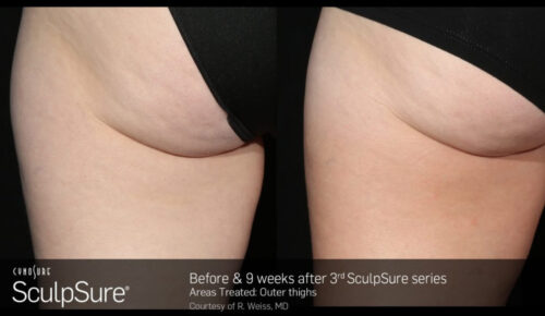 sculpsure-before-and-after-7-1
